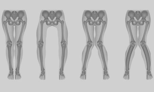 kemik-deformiteleri-cerrahisi-bursa-ortopedi