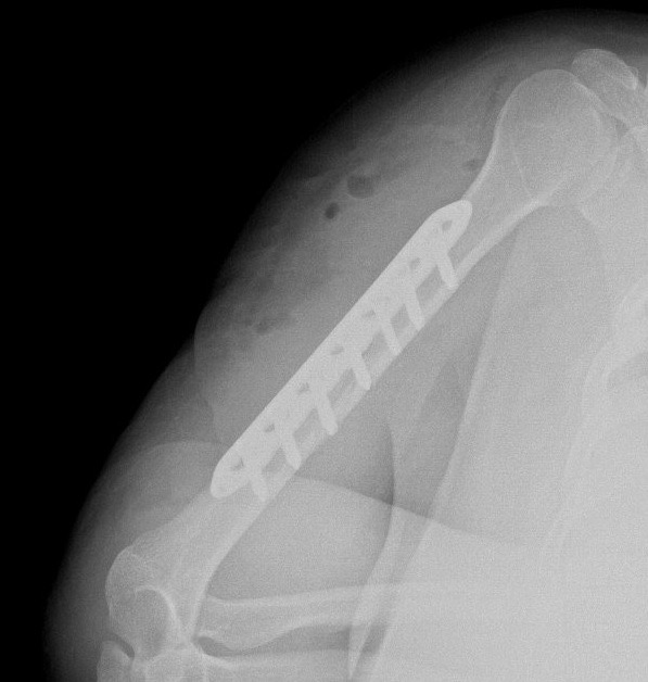 acil kırık tedavisi