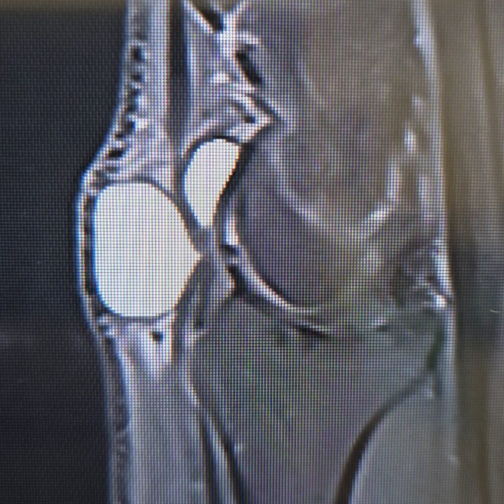 ganglion kisti mr görüntüsü