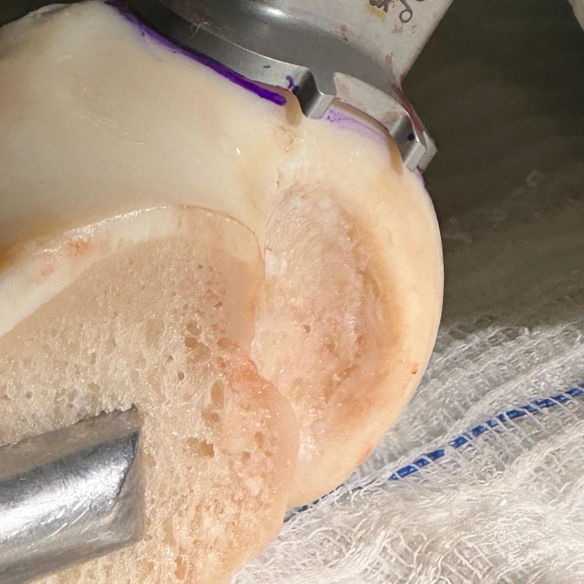 kıkırdak nakli ameliyatı