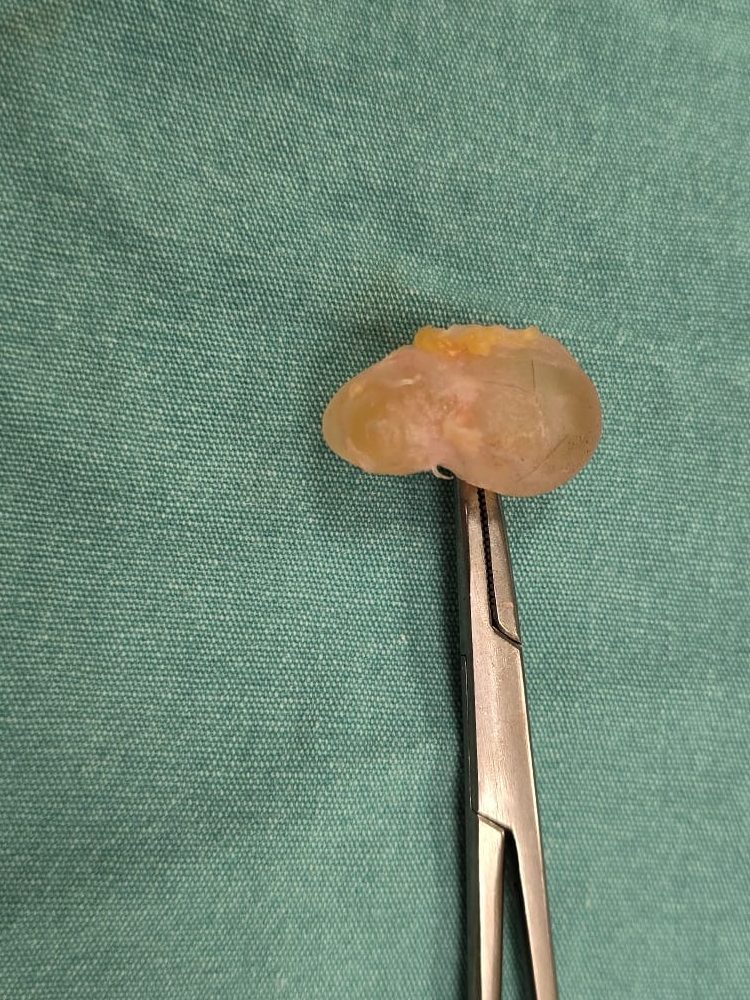 ganglion kisti tedavisi