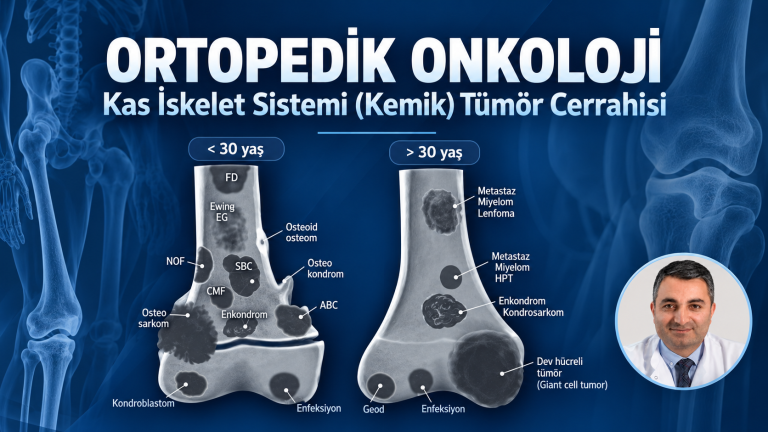 bursa-ortopedi-kemik-tumoru-kemik-kisti-ortopedik-onkoloji-hanifi-ucpunar